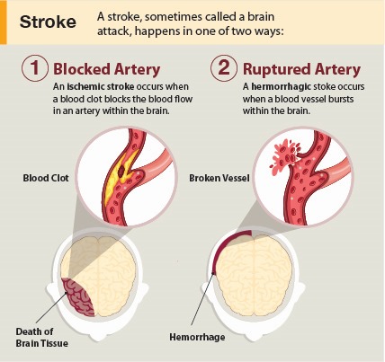 Blocked Arteries (Stroke)